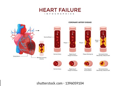 Heart Failure Medical Infographic Chart Composition Stock Vector ...