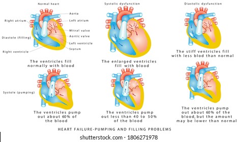 Heart Failure - Pumping And Filling Problems,  Systolic Dysfunction, Diastolic Dysfunction. Heart Failure Or Congestive Heart Failure. Diseases Of The Heart