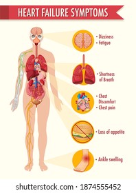 Heart Failure Symptoms Information Infographic Illustration