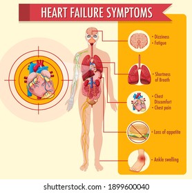 Heart Failure Symptoms Information Infographic Illustration Stock ...