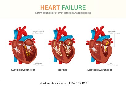 Heart Failure, Systolic Dysfunction, Diastolic Dysfunction