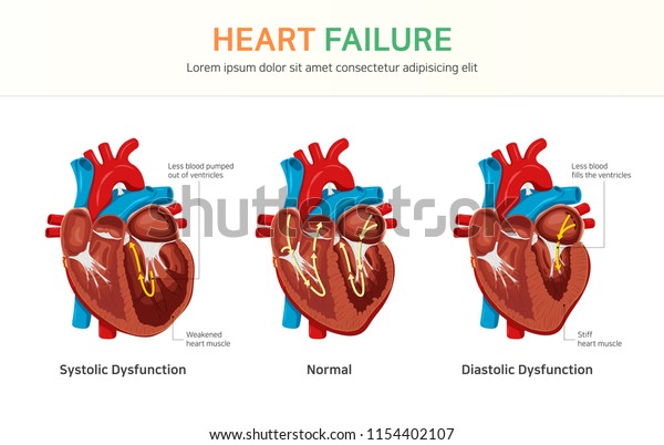 Heart failure, Systolic Dysfunction,\
Diastolic Dysfunction
