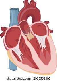 heart illustration showing implantation of self expanded TAVR valve