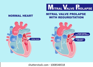 heart with mitral valve prolapse on the blue background