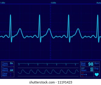 Heart Monitor Screen With Normal Beat Signal