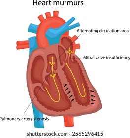 Heart murmurs. Pulmonary artery stenosis. Mitral valve insufficiency. Alternating circulation area