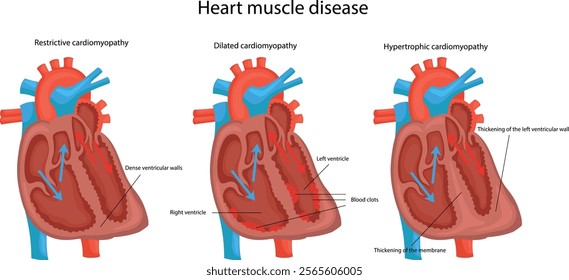 Heart muscle disease. Hypertrophic cardiomyopathy. Dilated cardiomyopathy. Restrictive cardiomyopathy. Left ventricular wall thickening. Membrane thickening. Densified ventricular walls.