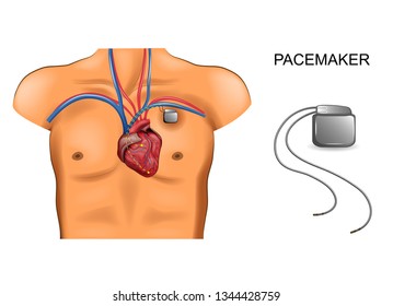 heart and pacemaker. cardiology