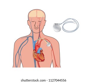 Herzschrittmacher. Anatomie Kreuzung des menschlichen Herzens mit einem implantierbaren Kardioverter-Defibrillator.