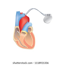 Herzschrittmacher bei der Arbeit. Anatomie Kreuzung des menschlichen Herzens mit einem implantierbaren Kardioverter-Defibrillator.