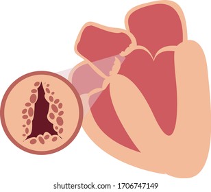 Heart showing aortic stenosis, aortic valve abnormality