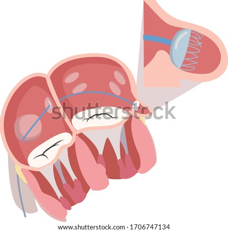 Heart showing left atrial appendage occlusion with occluding device