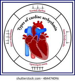 Heart Structure. The Organ Of The Circulatory System. Types Of Cardiac Arrhythmia: Sinus Tachycardia, Sinus Arrhythmia, Sinus Bradycardia, Normal Rhythm. Cardiogram.