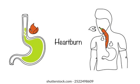 Acidez. Sensación de ardor en el esófago debido al reflujo de jugo gástrico hacia el esófago. El hombre experimenta una fuerte sensación de ardor como si hubiera comido pimiento rojo. Vector médico.