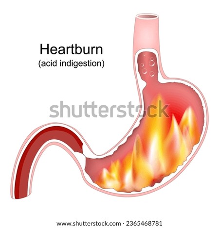 Heartburn. Cross section of a stomach with flame. Pyrosis, cardialgia or acid indigestion. burning sensation in the stomach. Gastroesophageal reflux disease GERD. Vector illustration