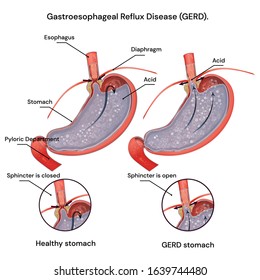 Heartburn and Gastroesophageal Reflux Disease (GERD). Acid reflux. 