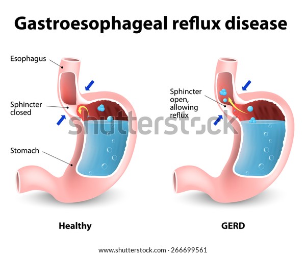 Heartburn and Gastroesophageal Reflux Disease\
(GERD). If the esophageal sphincter does not close tight enough,\
stomach acid seep back into the esophagus, damaging it and causing\
the heartburn