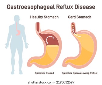 Heartburn or Gastroesophageal Reflux Disease. Stomach acid seep into the esophagus, damaging it and causing the heartburn. Digestive system internal organ disease. Flat vector illustration