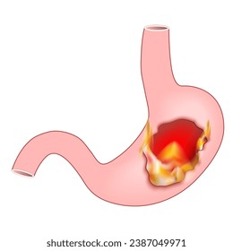 Heartburn. Human stomach with flame. Pyrosis, cardialgia or acid indigestion. burning sensation in the stomach. Gastroesophageal reflux disease GERD. Vector illustration