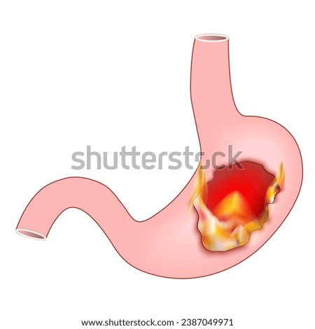 Heartburn. Human stomach with flame. Pyrosis, cardialgia or acid indigestion. burning sensation in the stomach. Gastroesophageal reflux disease GERD. Vector illustration