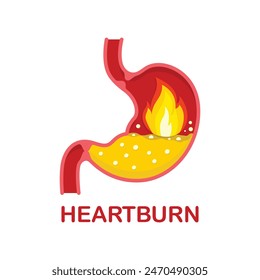 Heartburn, illustration of the stomach with fire, acute burning pain of heartburn.