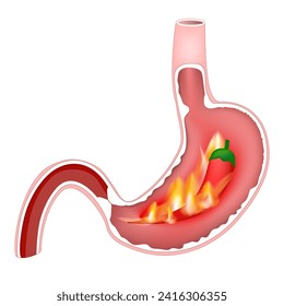 Heartburn of stomach. Cross section of stomach with hot flames and red chili pepper. Pyrosis, cardialgia or acid indigestion. burning sensation in the human digestive system. 