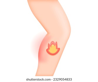 Heat in calves. Calves ache, pains, and hot like burning. symptoms of the disease. problems or disorders in the muscles or nerves. health issues. Minimalist 3D illustration design. vector elements