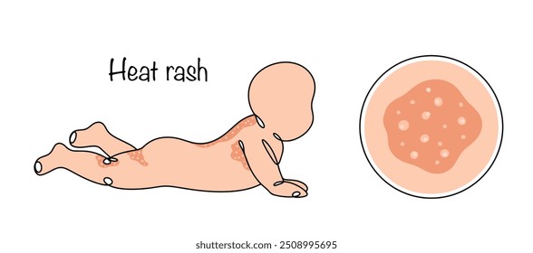 Erupção cutânea pelo calor. Uma doença de pele causada por sudorese excessiva. Ocorre com mais frequência em bebês. Um bebê com manifestações de uma doença de pele. Ilustração vetorial.