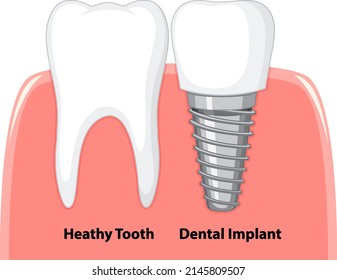 Heathy tooth and dental implant in gum on white background illustration