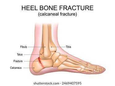 Heel bone fracture. Calcaneal fracture. Foot injury. Vector illustration.