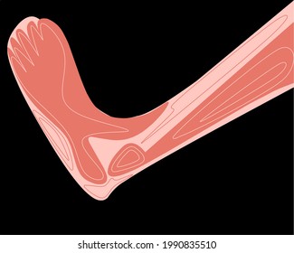 Heel bursitis inflammation. Inflamed bursa in human ankle. Achilles tendon and foot disease, pain and deformity. Diagnosis and treatment. Anatomical musculoskeletal poster, medical vector illustration
