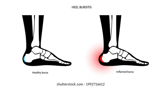 Heel bursitis inflammation. Inflamed bursa in human ankle. Achilles tendon and foot disease, pain and deformity. Diagnosis and treatment. Anatomical musculoskeletal poster, medical vector illustration