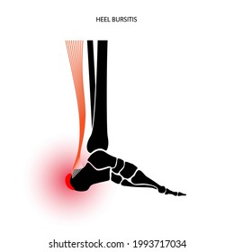 Heel bursitis inflammation. Inflamed bursa in human ankle. Achilles tendon and foot disease, pain and deformity. Diagnosis and treatment. Anatomical musculoskeletal poster, medical vector illustration