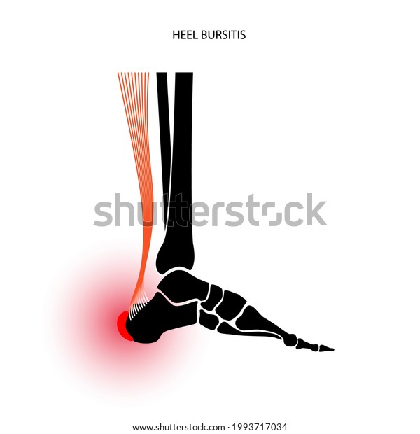 Heel Bursitis Inflammation Inflamed Bursa Human Stock Vector (Royalty