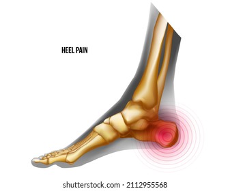 Heel of foot pain bones skeleton realistic illustration. Medial view. Anatomy of joints, human leg realistic black and yellow transparente skeleton. For medical orthopedic advertising. Vector illustra