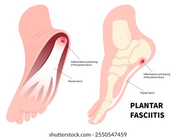 Heel pain and swelling in medical called Plantar Fasciitis of flat feet syndrome