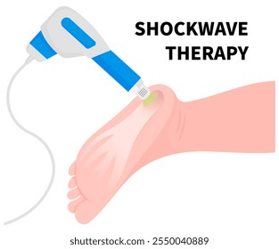 Heel pain treatment by Shockwave therapy to treat muscle repetitive strain tear or overuse injury with Golfer’s elbow syndrome and Morton’s neuroma disease in medical