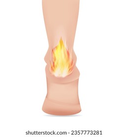 Heel spur, aches, hot burn sensation. Vector illustrations.