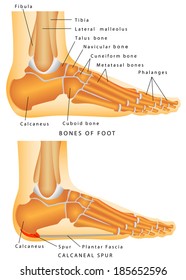 Heel Spur. Bones of the Foot and Ankle. Calcaneal spur. Calcaneal spur a bone excrescence on the lower surface of the calcaneus which frequently causes pain on walking