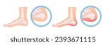 Heel spur illustration. Design elements on the theme of plantar fasciitis. Vector set.