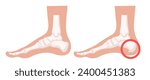 Heel spur illustration. Design elements on the theme of plantar fasciitis. Vector set.