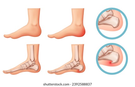 Helfen Sie die Illustration. Design-Elemente zum Thema Plantarfasciitis. Vektorset.