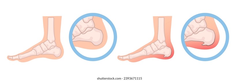 Heel spur illustration. Design elements on the theme of plantar fasciitis. Vector set.