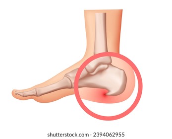 Heel spur illustration. Design elements on the theme of plantar fasciitis.