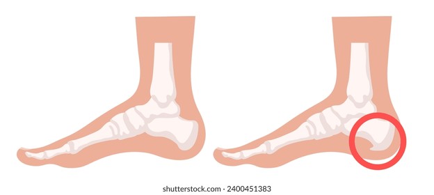 Heel spur illustration. Design elements on the theme of plantar fasciitis. Vector set.