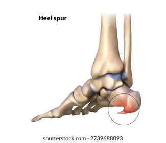Heel spur. Isolated vector illustration