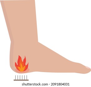 Heel spur on foot vector illustration