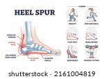 Heel spur problem or calcaneal bone condition causing pain in feet outline diagram. Labeled educational medical scheme with achilles tendon and plantar fascia inflammation anatomy vector illustration.