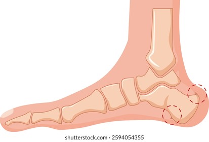 heel spur syndrome causing pain over heel vector 