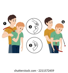 Heimlich's maneuver. First aid procedure for choking due to obstruction of the upper respiratory tract by foreign bodies. Vector flat illustration